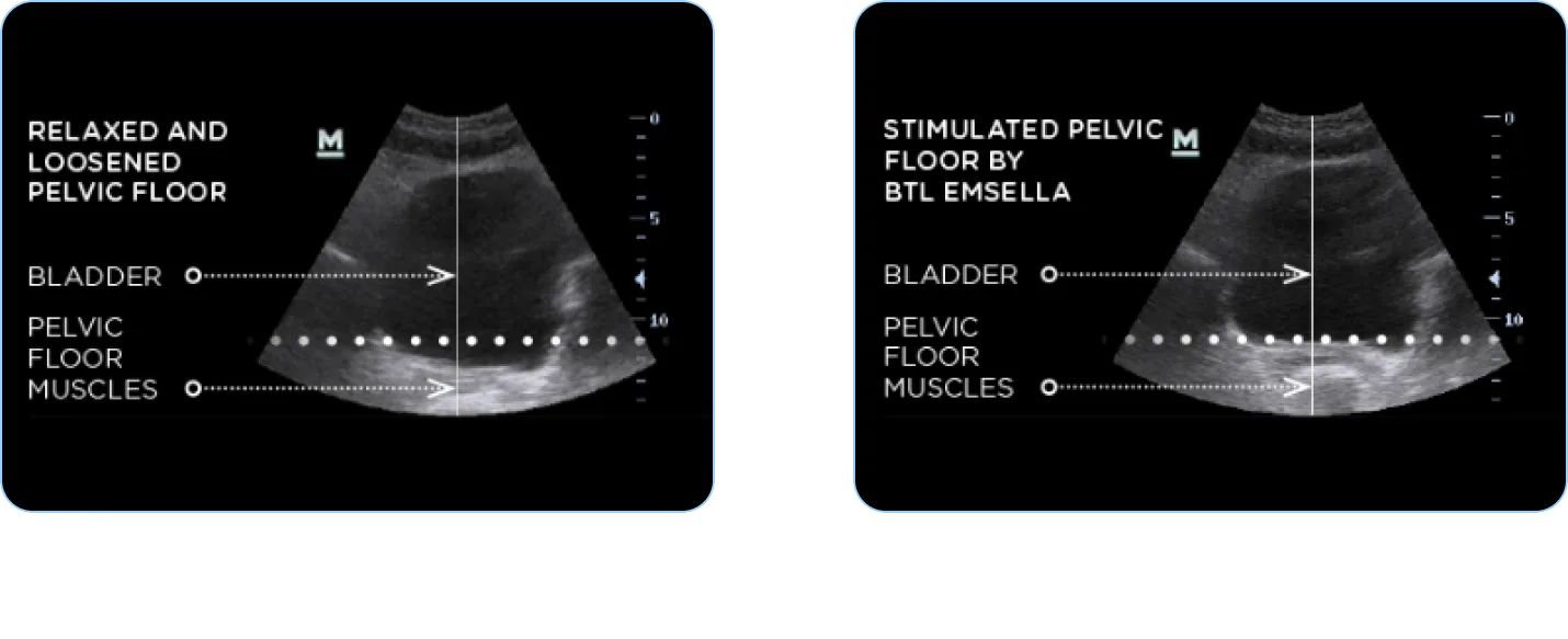 Pelvic floor anatomy, before and after Emsella treatment