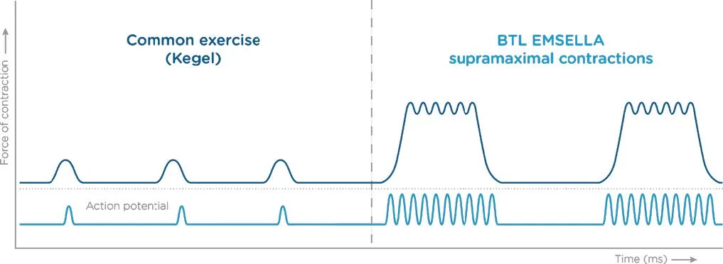 Emsella vs Kegels: 11,200 supramaximal contractions per session